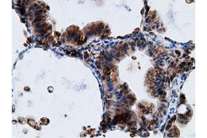 Immunohistochemical staining of paraffin-embedded Adenocarcinoma of Human breast tissue using anti-KHK mouse monoclonal antibody. (Ketohexokinase 抗体)