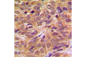 Immunohistochemical analysis of FOXO4 (pS197) staining in human breast cancer formalin fixed paraffin embedded tissue section. (FOXO4 抗体  (pSer197))