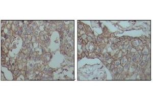 Immunohistochemical analysis of paraffin-embedded human breast carcinoma tissues, showing membrane localization with DAB staining using CD44 antibody. (CD44 抗体)