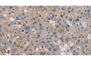 Immunohistochemistry of paraffin-embedded Human breast cancer using CLIC1 Polyclonal Antibody at dilution of 1:30 (CLIC1 抗体)