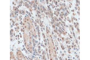 Immunohistochemistry of paraffin-embedded Human gastric cancer using ZNF562 Polyclonal Antibody at dilution of 1:100 (40x lens). (ZNF562 抗体)