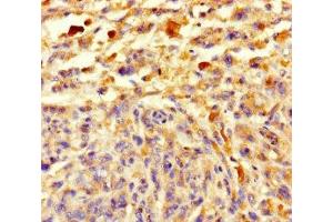 Immunohistochemistry of paraffin-embedded human melanoma using ABIN7148108 at dilution of 1:100 (C12ORF68 抗体  (AA 1-194))