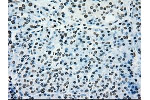 Immunohistochemical staining of paraffin-embedded Adenocarcinoma of colon tissue using anti-SILV mouse monoclonal antibody. (Melanoma gp100 抗体)