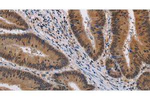 Immunohistochemistry of paraffin-embedded Human colon cancer using KCNG4 Polyclonal Antibody at dilution of 1:40