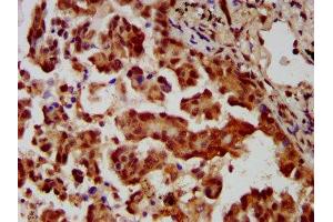IHC image of ABIN7159000 diluted at 1:400 and staining in paraffin-embedded human lung cancer performed on a Leica BondTM system. (MBIP 抗体  (AA 91-241))