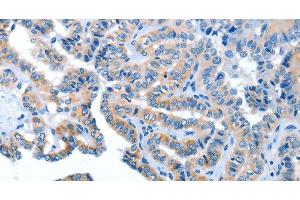 Immunohistochemistry of paraffin-embedded Human thyroid cancer using AMDHD2 Polyclonal Antibody at dilution of 1:40 (AMDHD2 抗体)