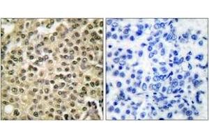 Immunohistochemistry analysis of paraffin-embedded human breast carcinoma tissue, using RAN Antibody. (RAN 抗体  (AA 167-216))