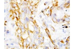 IHC-P: beta Defensin 1 antibody testing of lung cancer tissue (beta Defensin 1 抗体  (C-Term))