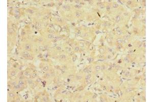 Immunohistochemistry of paraffin-embedded human liver cancer using ABIN7152170 at dilution of 1:100 (EIF3K 抗体  (AA 1-218))
