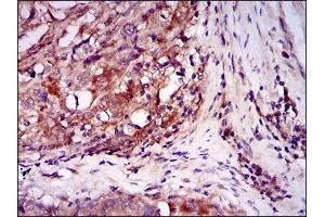 Immunohistochemical analysis of paraffin-embedded esophageal cancer tissues using ILK mouse mAb with DAB staining. (ILK 抗体  (AA 97-244))