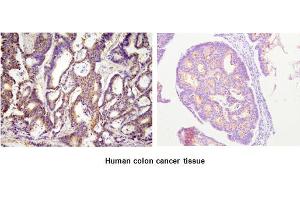 Paraffin embedded sections of human colon cancer tissue were incubated with anti-human ACOT11 (1:100) for 2 hours at room temperature. (ACOT11 抗体)