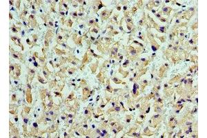 Immunohistochemistry of paraffin-embedded human liver cancer using ABIN7149003 at dilution of 1:100 (CST7 抗体  (AA 20-145))