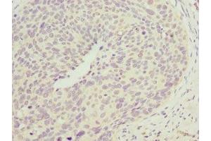 Immunohistochemistry of paraffin-embedded human cervical cancer using ABIN7147492 at dilution of 1:100 (CCM2 抗体  (AA 1-300))
