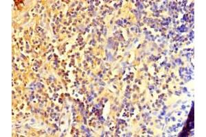Immunohistochemistry of paraffin-embedded human bladder cancer using ABIN7150017 at dilution of 1:100 (DIS3L2 抗体  (AA 201-400))