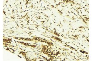 ABIN6269171 at 1/100 staining Human breast cancer tissue by IHC-P. (JunD 抗体)