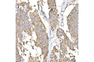 Immunohistochemistry of paraffin-embedded human lung cancer using USO1 Rabbit mAb (ABIN7271234) at dilution of 1:25 (40x lens). (USO1 抗体)