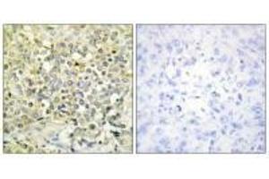 Immunohistochemistry analysis of paraffin-embedded human lung carcinoma tissue using CDKL4 antibody. (CDKL4 抗体  (C-Term))