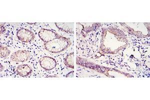 Immunohistochemical analysis of paraffin-embedded gastric cancer tissues (left) and lung cancer tissues (right) using CDH1 antibody with DAB staining. (E-cadherin 抗体)