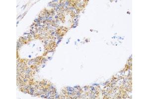 Immunohistochemistry of paraffin-embedded Human colon carcinoma using ZAK Polyclonal Antibody at dilution of 1:100 (40x lens). (ZAK 抗体)