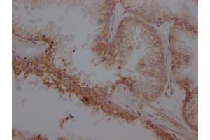 IHC image of ABIN7127366 diluted at 1:100 and staining in paraffin-embedded human prostate cancer performed on a Leica BondTM system. (Recombinant beta 2 Adrenergic Receptor 抗体)