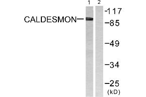 Immunohistochemistry analysis of paraffin-embedded human breast carcinoma tissue using Caldesmon (Ab-789) antibody. (Caldesmon 抗体  (Ser789))
