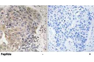 Immunohistochemistry analysis of paraffin-embedded human lung carcinoma tissue using AGBL3 polyclonal antibody .