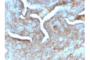 Formalin-fixed, paraffin-embedded human Prostate Carcinoma stained with Thymidine Phosphorylase Rabbit Recombinant Monoclonal (TYMP/2890R). (Recombinant Thymidine Phosphorylase 抗体)