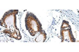 Immunohistochemistry of paraffin-embedded Human colorectal cancer using ARFGAP2 Polyclonal Antibody at dilution of 1/25 (arfgap2 抗体)
