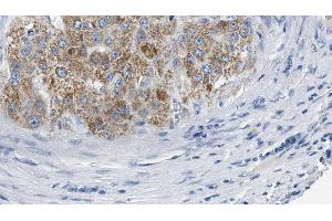 ABIN6274572 at 1/100 staining Human liver cancer tissue by IHC-P. (Serotonin Receptor 2B 抗体  (Internal Region))