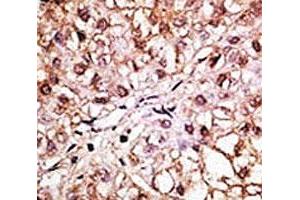 IHC analysis of FFPE human hepatocarcinoma tissue stained with the BNIP3L antibody (BNIP3L/NIX 抗体  (AA 122-152))