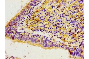 Immunohistochemistry of paraffin-embedded human lung cancer using ABIN7146450 at dilution of 1:100 (CACYBP 抗体  (AA 2-228))
