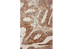 Anti- BCL2L2 antibody, IHC(P) IHC(P): Human Rectal Cancer Tissue (BCL2L2 抗体  (Middle Region))