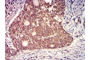 Immunohistochemical analysis of paraffin-embedded cervical cancer tissues using CD130 mouse mAb with DAB staining. (CD130/gp130 抗体  (AA 73-231))
