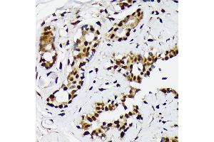 Immunohistochemistry of paraffin-embedded human breast cancer using ILF2 Rabbit mAb (ABIN7268007) at dilution of 1:100 (40x lens). (ILF2 抗体)