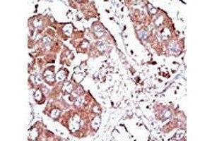 IHC analysis of FFPE human hepatocarcinoma tissue stained with the ALK3 antibody (BMPR1A 抗体  (AA 166-195))