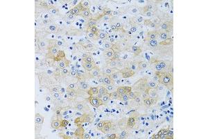 Immunohistochemistry of paraffin-embedded human liver using SLC4 antibody (ABIN6132890, ABIN6148015, ABIN6148016 and ABIN6214688) at dilution of 1:100 (40x lens). (NBC4 抗体  (AA 1042-1121))