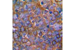 Immunohistochemical analysis of MKK1 staining in human prostate cancer formalin fixed paraffin embedded tissue section. (MEK1 抗体  (Center))