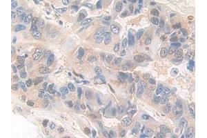 Detection of PDXK in Human Breast cancer Tissue using Polyclonal Antibody to Pyridoxal Kinase (PDXK)