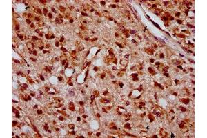 IHC image of ABIN7176263 diluted at 1:400 and staining in paraffin-embedded human glioma performed on a Leica BondTM system. (ZNF367 抗体  (AA 83-151))