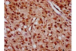 IHC image of ABIN7176263 diluted at 1:400 and staining in paraffin-embedded human glioma performed on a Leica BondTM system. (ZNF367 抗体  (AA 83-151))