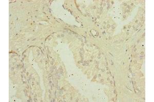 Immunohistochemistry of paraffin-embedded human prostate cancer using ABIN7159922 at dilution of 1:100 (MIPEP 抗体  (AA 504-713))