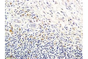 Formalin-fixed and paraffin embedded human colorectal cancer labeled with Anti-LI-cadherin Polyclonal Antibody, Unconjugated (ABIN732128) followed by conjugation to the secondary antibody and DAB staining (LI Cadherin 抗体  (AA 101-200))
