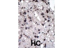 Formalin-fixed and paraffin-embedded human cancer tissue reacted with the primary antibody, which was peroxidase-conjugated to the secondary antibody, followed by DAB staining. (Hexokinase 2 抗体  (AA 401-431))