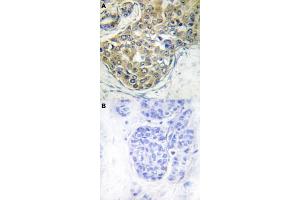 Immunohistochemical staining (Formalin-fixed paraffin-embedded sections) of human breast cancer tissue with TNK2 (phospho Y284) polyclonal antibody  without blocking peptide (A) or preincubated with blocking peptide (B) under 1:50-1:100 dilution. (TNK2 抗体  (pTyr284))