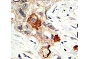 IHC analysis of FFPE human breast carcinoma tissue stained with the UBE2I antibody (UBE2I 抗体  (AA 1-30))