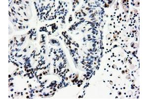 Immunohistochemical staining of paraffin-embedded Adenocarcinoma of Human breast tissue using anti-NT5DC1 mouse monoclonal antibody. (NT5DC1 抗体)
