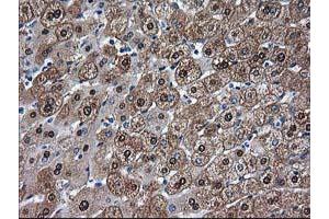 Immunohistochemical staining of paraffin-embedded Human liver tissue using anti-ADH1B mouse monoclonal antibody. (ADH1B 抗体)