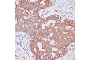 Immunohistochemistry of paraffin-embedded human breast cancer using KCNH2 antibody (ABIN3023435, ABIN3023436, ABIN3023437 and ABIN6219948) at dilution of 1:100 (40x lens). (KCNH2 抗体)