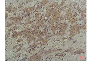 Immunohistochemistry (IHC) analysis of paraffin-embedded Human Breast Carcinoma using P44/42 MAPK (ERK1/2) Mouse Monoclonal Antibody diluted at 1:200. (ERK1/2 抗体)