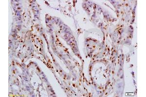 Formalin-fixed and paraffin embedded human colon carcinoma labeled with Rabbit Anti KLF4 Polyclonal Antibody, Unconjugated (ABIN737121) at 1:200 followed by conjugation to the secondary antibody and DAB staining (KLF2/4 抗体  (AA 415-513))